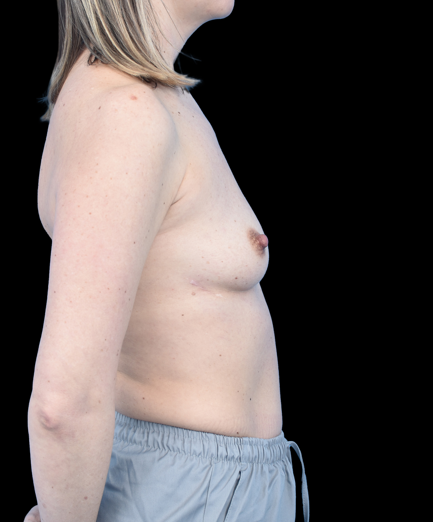 Harmonizacja piersi MIA Wrocław