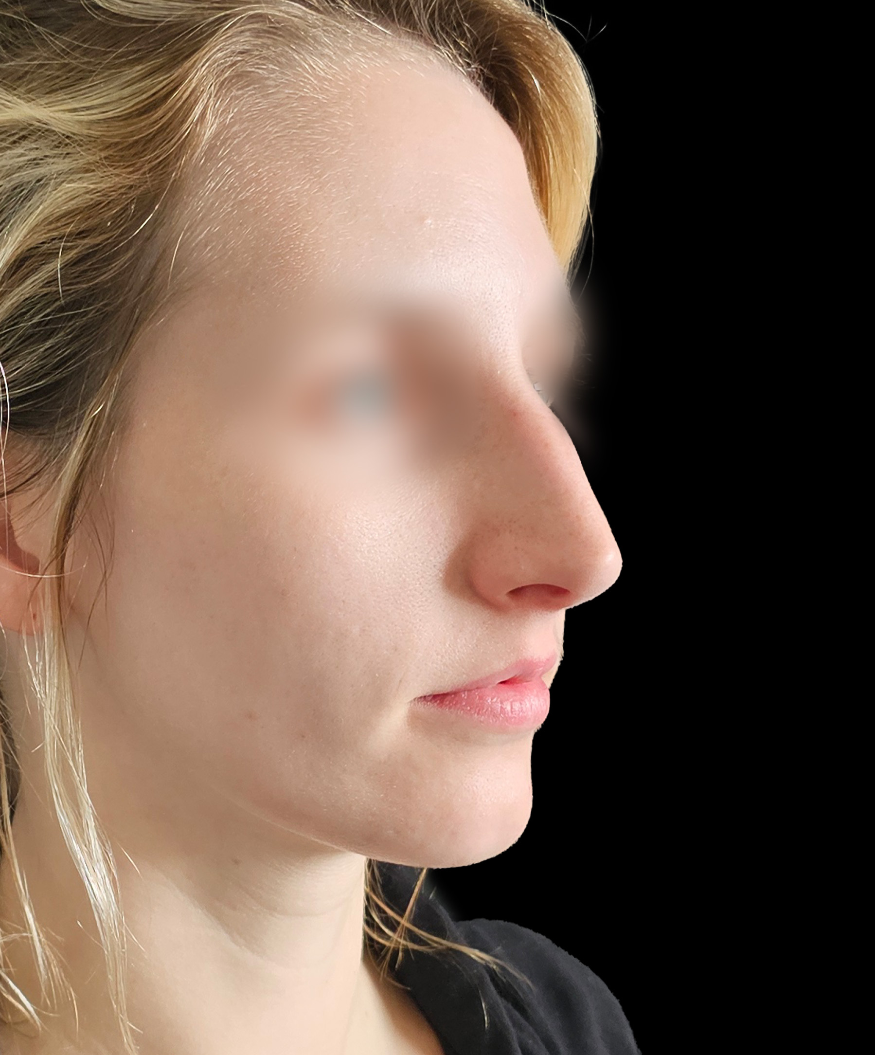 Plastyka nosa Wrocław