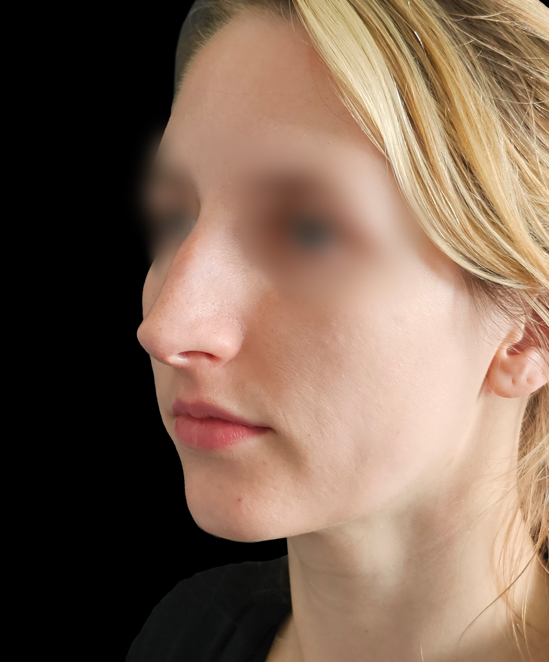 Plastyka nosa Wrocław