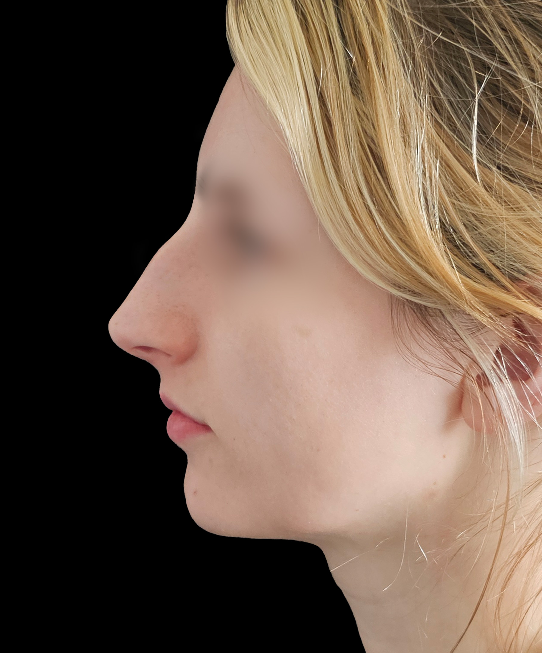 Plastyka nosa Wrocław