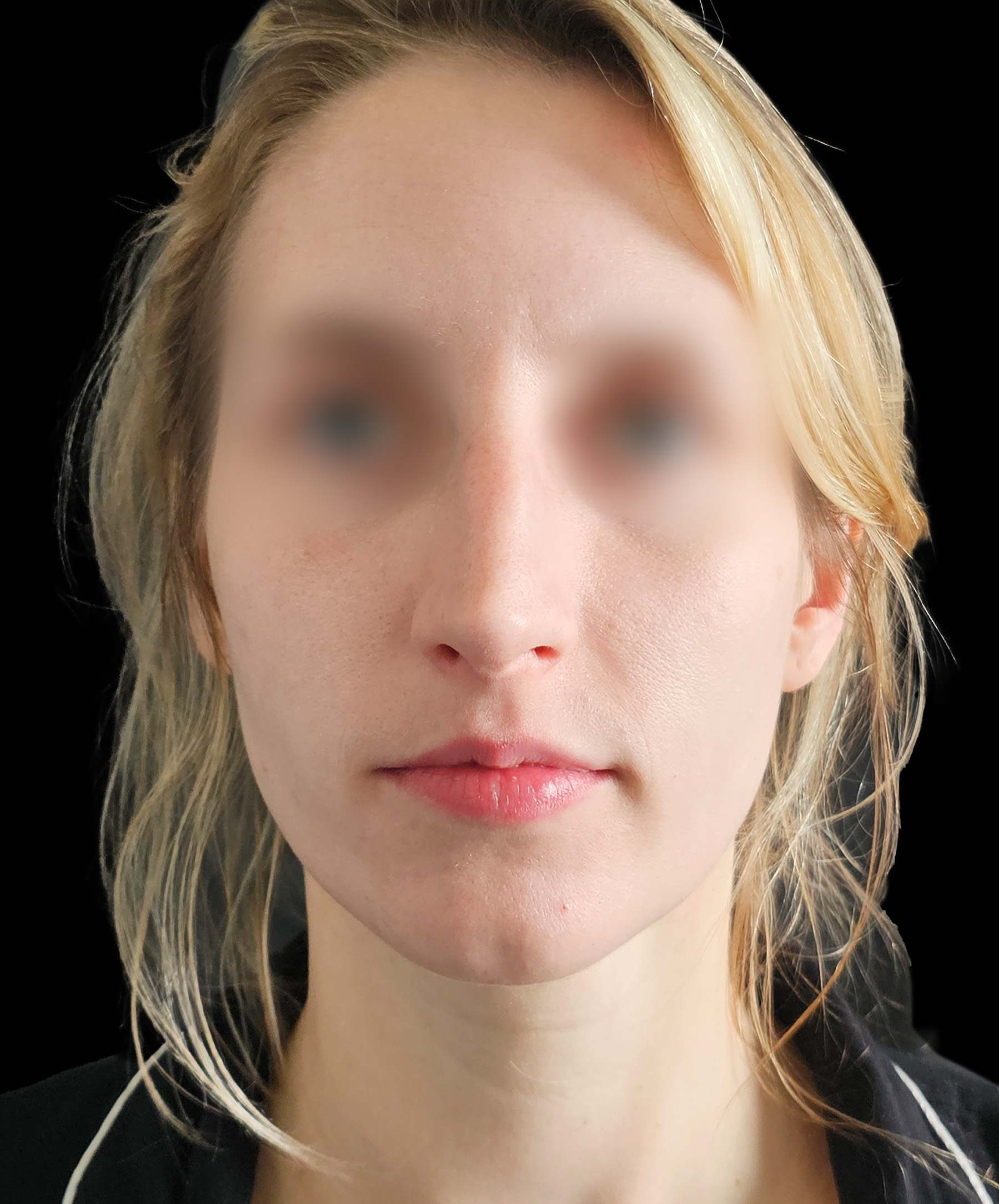 Plastyka nosa Wrocław