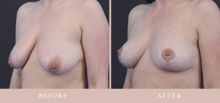Podniesienie piersi - chirurgia plastyczna