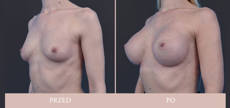 Powiększenie piersi - chirurgia plastyczna