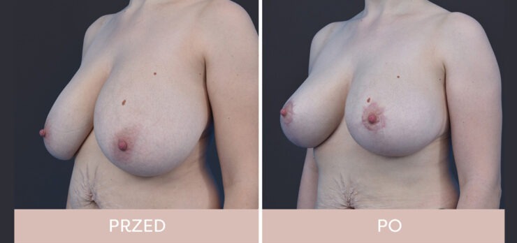 Chirurgia plastyczna - redukcja piersi