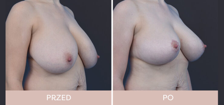 Chirurgia plastyczna - redukcja piersi