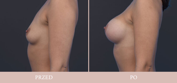 Powiększenie piersi - chirurgia plastyczna