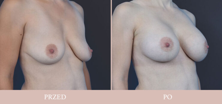 Chirurgia plastyczna - powiększenie piersi