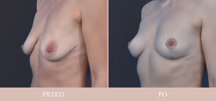 Podniesienie piersi - chirurgia plastyczna