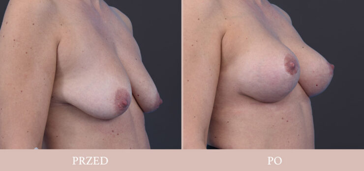 Chirurgia plastyczna - podniesienie piersi wraz z powiększeniem
