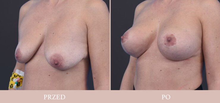Chirurgia plastyczna - podniesienie piersi wraz z powiększeniem