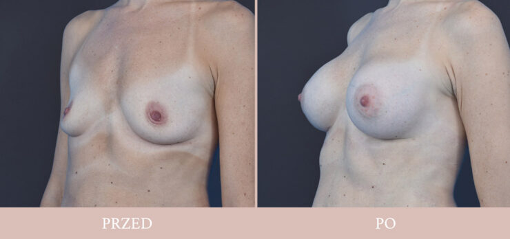 Powiększenie piersi galeria przed i po