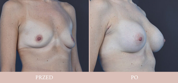 Powiększenie piersi galeria przed i po