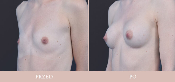 Powiększanie piersi - chirurgia plastyczna dr Kołacz