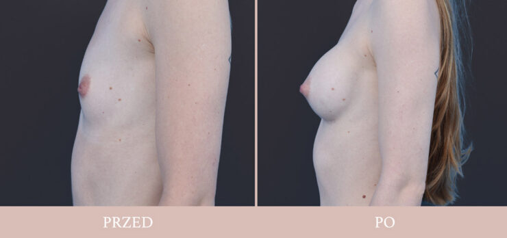 Powiększanie piersi - chirurgia plastyczna dr Kołacz