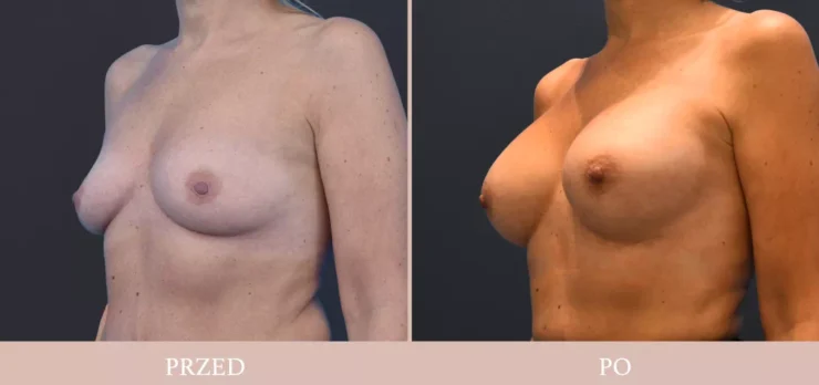 Chirurgia plastyczna - powiększenie piersi