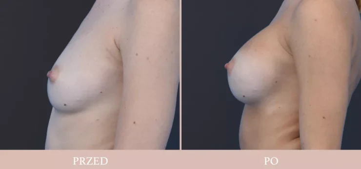 Powiększenie piersi - chirurgia plastyczna piersi