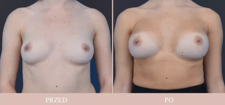 Powiększenie piersi - chirurgia plastyczna piersi