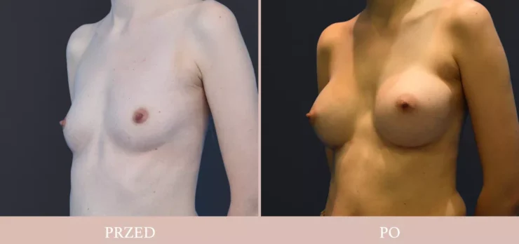 Chirurgia plastyczna - powiększenie piersi przed/po