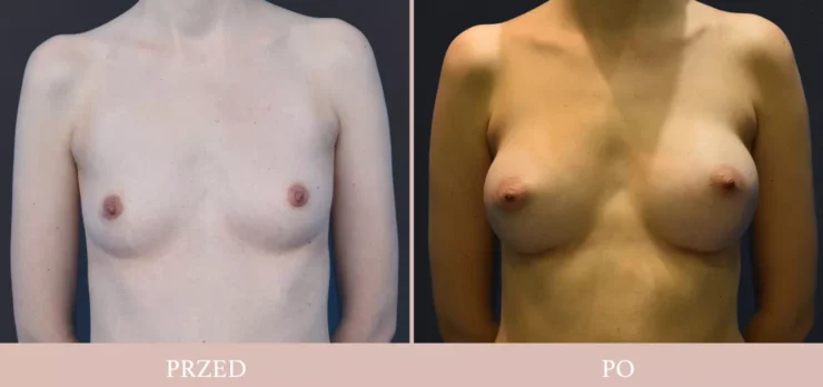 Chirurgia plastyczna - powiększenie piersi przed/po