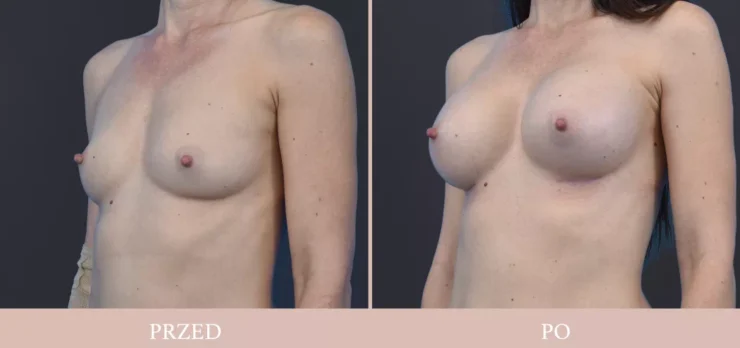 Galeria przed/po - chirurgia plastyczna piersi