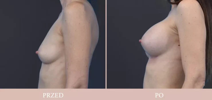 Galeria przed/po - chirurgia plastyczna piersi