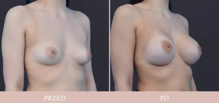 Chirurgia plastyczna piersi - powiększenie