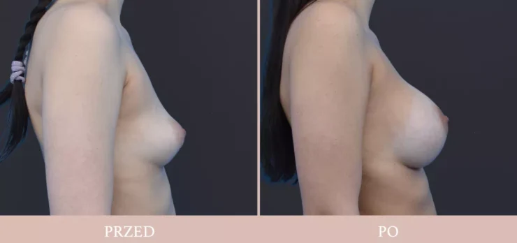 Chirurgia plastyczna piersi - powiększenie
