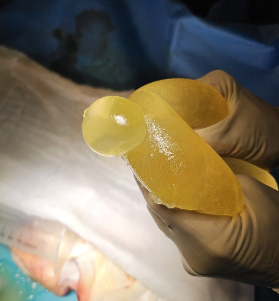 Pęknięty implant piersiowy Wrocław Wymiana implantów piersiowych Wrocłąw