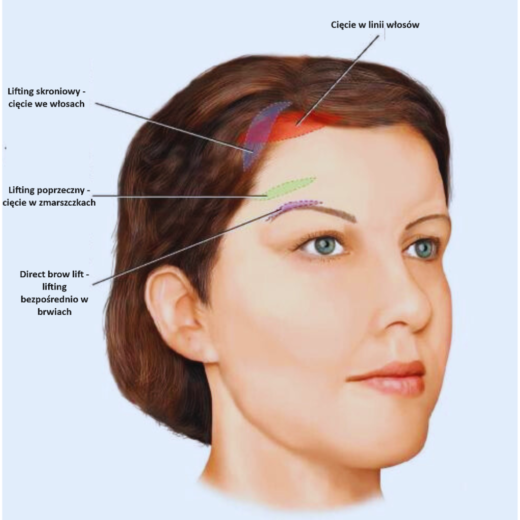 Lifting czoła i brwi Wrocław - lokalizacja blizn na twarzy