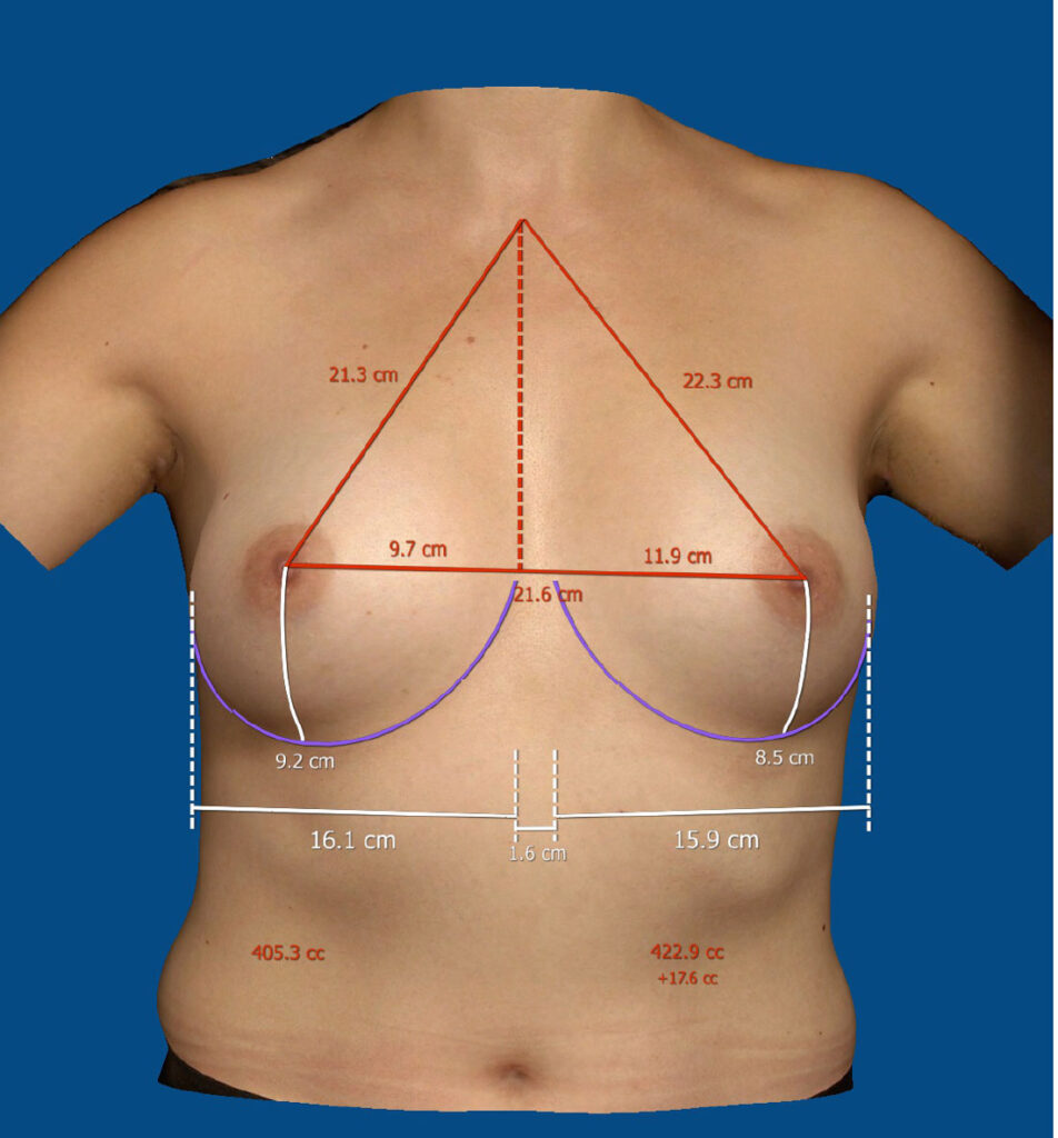 Symulacja 3D powiększenia piersi Wrocław