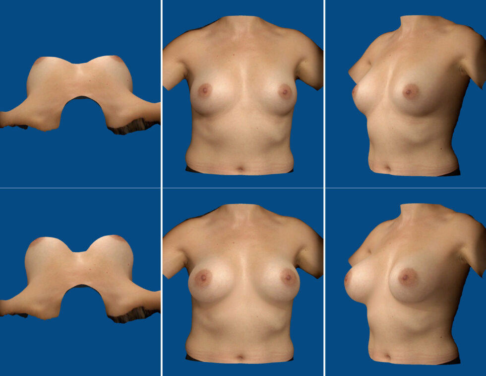 Wizualizacja 3D powiększenie biustu implantami piersiowymi Wrocław