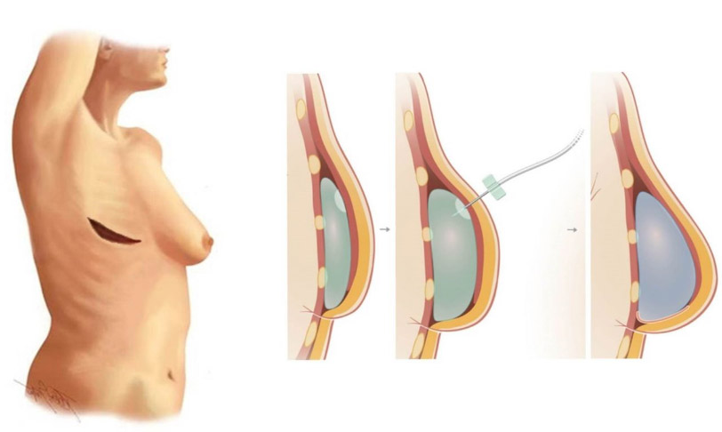Profilaktyczna mastektomia Wrocław- zdjęcie przedstawiające zabieg wszczepienia ekspandera tkankowego podczas profilaktycznej mastektomii. Ekspander jest umieszczany pod skórą pacjentki jako pierwszy etap rekonstrukcji piersi po mastektomii. Procedura ta pomaga w przygotowaniu miejsca do późniejszego wszczepienia implantu, co jest istotnym krokiem w procesie odbudowy piersi. Zdjęcie obrazuje kluczowy moment chirurgicznego zabiegu, który zapewnia pacjentkom większą pewność siebie i komfort po profilaktycznej mastektomii
