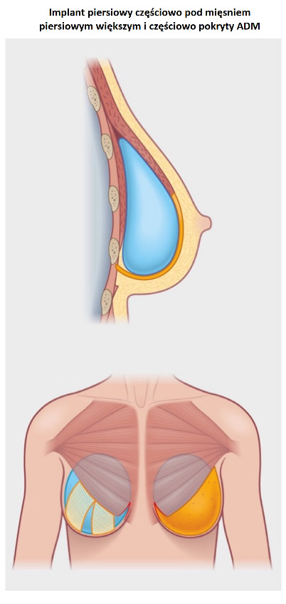 Wszczepienie implantu piersiowego podczas profilaktycznej mastektomii Wrocław