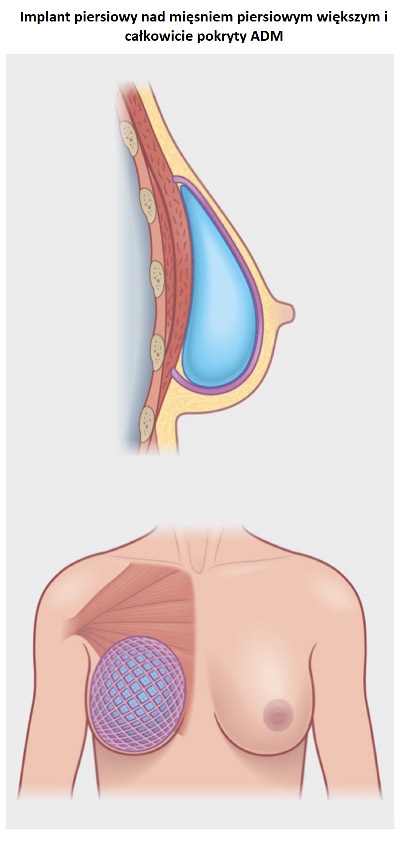 Wszczepienie implantu piersiowego podczas profilaktycznej mastektomii – chirurg w trakcie zabiegu, z bliska widoczny implant i techniki operacyjne. Procedura ma na celu zmniejszenie ryzyka raka piersi u pacjentek. Zdjęcie ilustruje nowoczesne podejście do profilaktyki onkologicznej