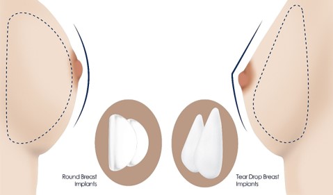 Powiększenie piersi Wrocław
