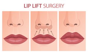Lip lift Wroclaw