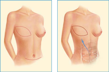 Rekonstrukcja piersi z zastosowaniem mięśnia prostego brzucha TRAM Wrocław – metoda odbudowy piersi po mastektomii
