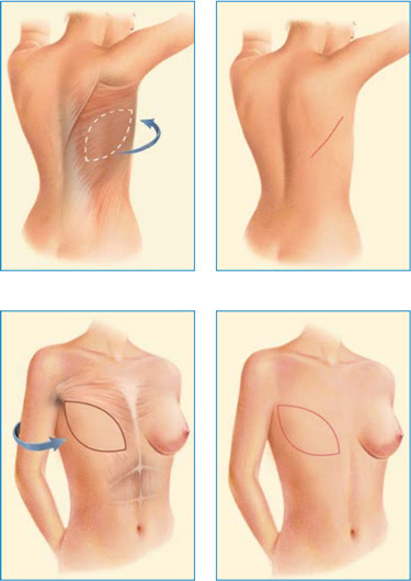 Rekonstrukcja piersi z zastosowaniem mięśnia najszerszego grzbietu LD oraz ekspandera i implantu piersiowego Wrocław – metoda odbudowy piersi po mastektomii