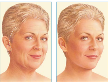 Lifting twarzy Wrocław- zabieg medycyny estetycznej, poprawiający kontur i elastyczność skóry. Na zdjęciu widać uśmiechniętą kobietę z gładką skórą po zabiegu, co podkreśla naturalny efekt odmłodzenia. Lifting twarzy to popularna metoda we Wrocławiu, oferująca szybkie rezultaty i minimalny czas rekonwalescencji.