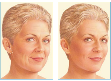 Mini Lifting twarzy Wrocław - zabieg medycyny estetycznej, poprawiający kontur i elastyczność skóry. Na zdjęciu widać uśmiechniętą kobietę z gładką skórą po zabiegu, co podkreśla naturalny efekt odmłodzenia. Lifting twarzy to popularna metoda we Wrocławiu, oferująca szybkie rezultaty i minimalny czas rekonwalescencji.