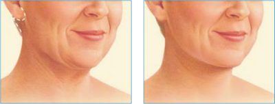 Lifting szyi Wrocław- zabieg medycyny estetycznej, poprawiający kontur i elastyczność skóry. Na zdjęciu widać uśmiechniętą kobietę z gładką skórą po zabiegu, co podkreśla naturalny efekt odmłodzenia. Lifting szyi to popularna metoda we Wrocławiu, oferująca szybkie rezultaty i minimalny czas rekonwalescencji.