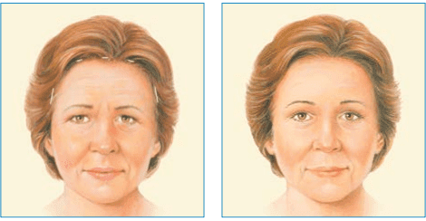 Endoskopowy lifting czoła i brwi Wrocław- lokalizacja blizn