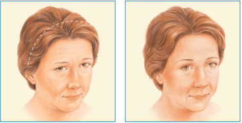 Lifting czoła i brwi - efekty przed i po zabiegu, poprawa wyglądu twarzy i uniesienie brwi, chirurgia plastyczna, estetyka, medycyna estetyczna