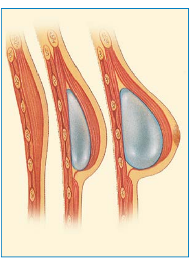 Rekonstrukcja piersi z zastosowaniem ekspandera i implantu Wrocław– metoda odbudowy piersi po mastektomii