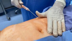 pobranie tkanki tłuszczowej przeszczep tkanki tłuszczowej Wrocław