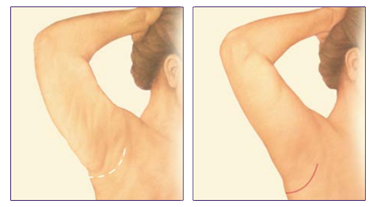 Plastyka ramion Wrocław