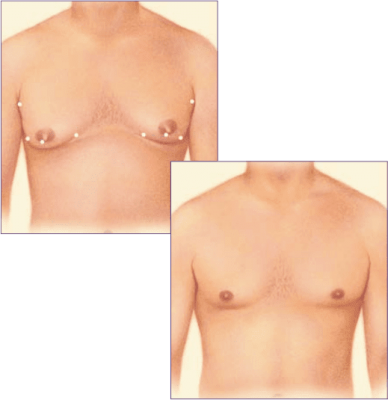 Zdjęcie przedstawia możliwe lokalizacje blizn ginekomastii