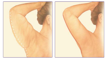 Blizna plastyka ramion Wrocław