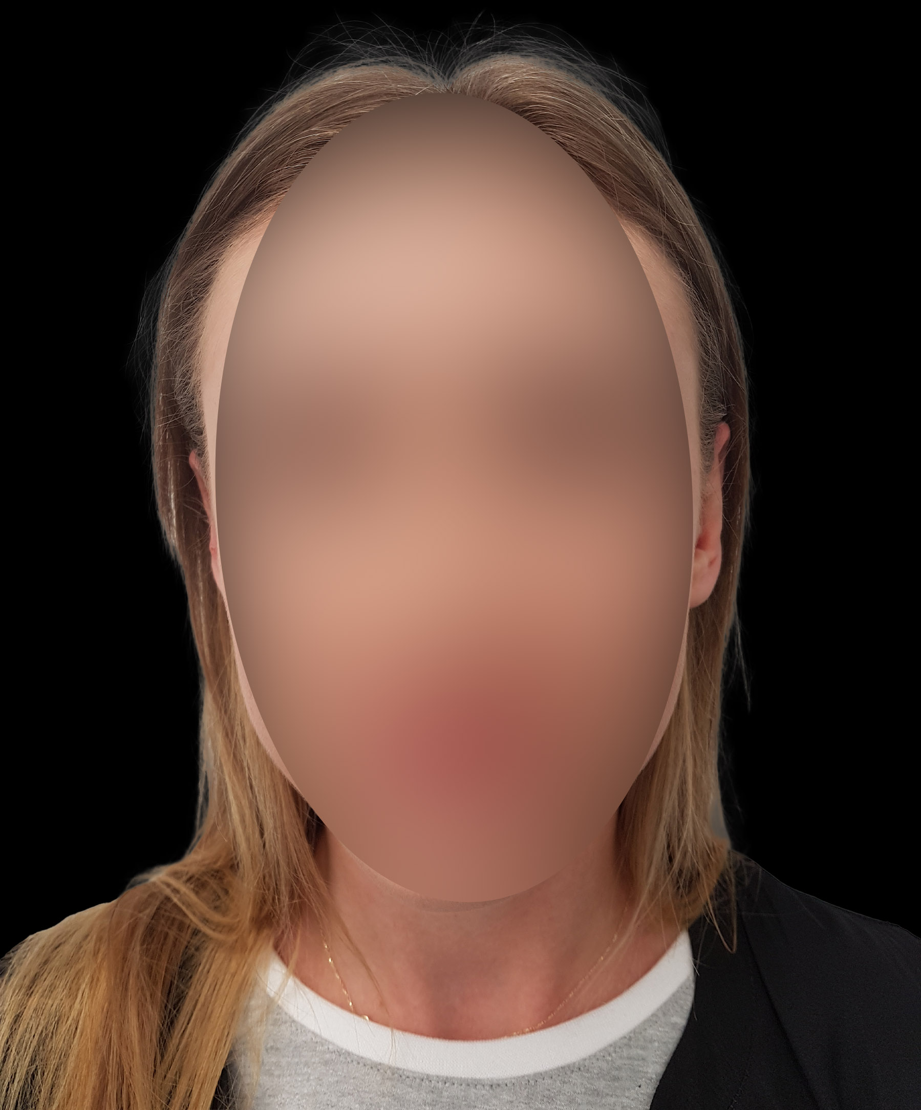 Dyskretny efekt operacji odstających uszu wykonanej przez dr Kołacza we Wrocławiu