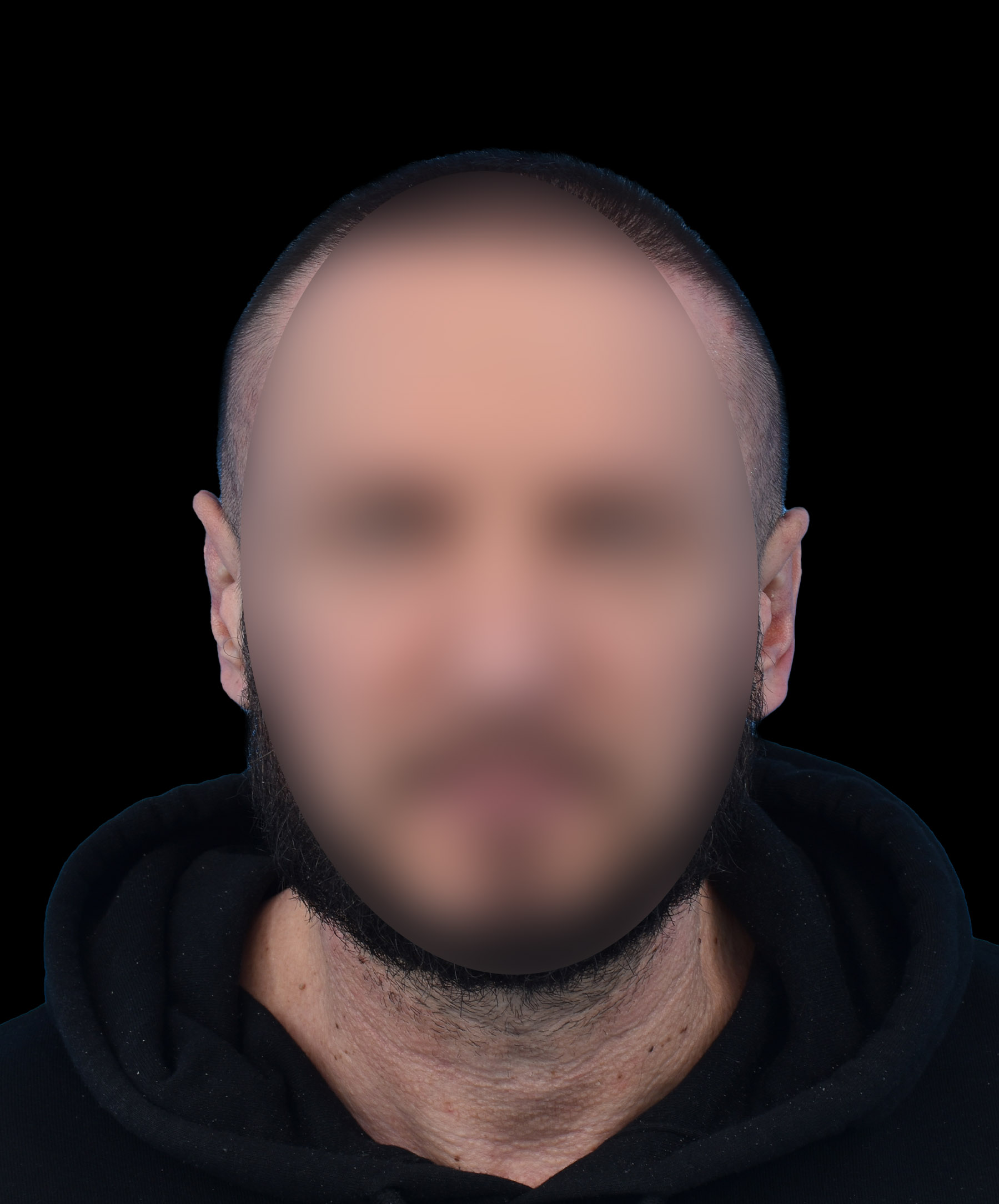 Efekt korekcji odstających uszu wykonanej przez dr Kołacza we Wrocławiu